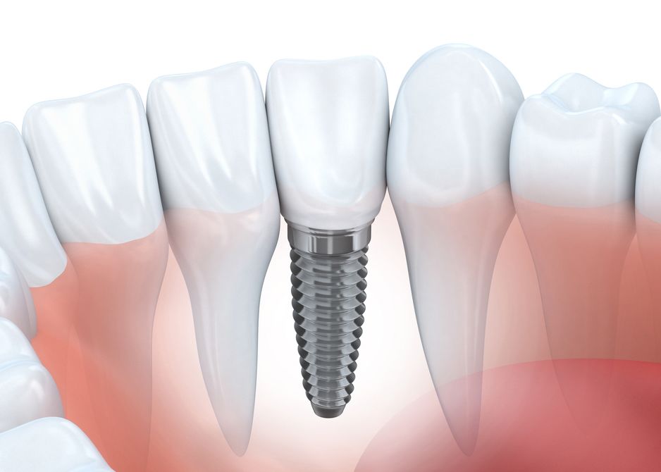 A young woman shows off a smile supported by dental implants.